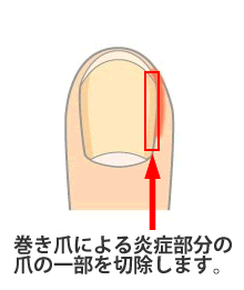 巻き爪による炎症部分の爪を一部を切除します。